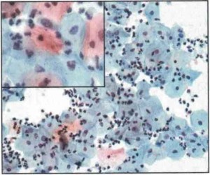 LOW SIL (infezione da Human Papilloma Virus)